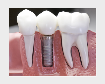 Bild: Implantate