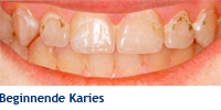 Kariesbehandlung Kariesbehandlung mit Icon