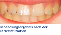 Kariesbehandlung Behandlungsergebnis mit Icon