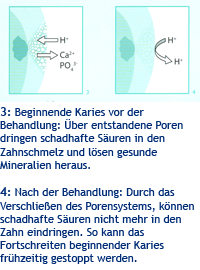 Kariesbehandlung Kariesbehandlung mit Icon