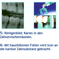 Kariesbehandlung Kariesbehandlung mit Icon